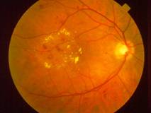 edema macular